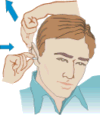 Inserting a ear plug